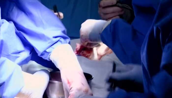 Cirujanos estadounidenses trasplantan corazón de cerdo a paciente humano