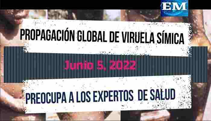Propagación global de viruela símica preocupa a los expertos de salud