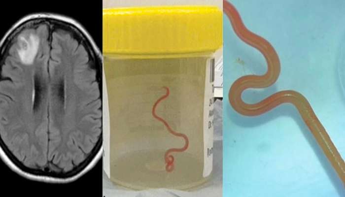 Por primera vez se encuentra un gusano vivo en el cerebro de una persona